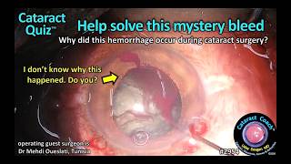 CataractCoach™ 2954: CataractQuiz™: Help solve this mystery bleeding