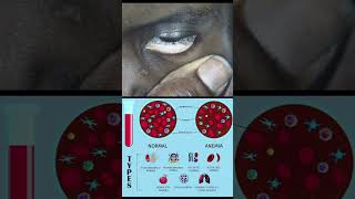 Dhiig-Yari Anemia