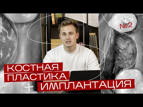 Установка имплантата с направленной костной регенерацией. Sausage Technique. Игорь Налиткин.