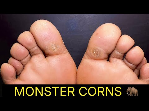 SHAVING TWO MONSTER CORNS!