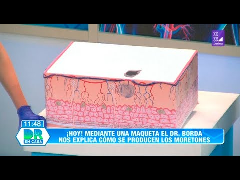 Vídeo: Moretones Después De La Extracción De Sangre: Por Qué, Qué Hacer Y Prevención