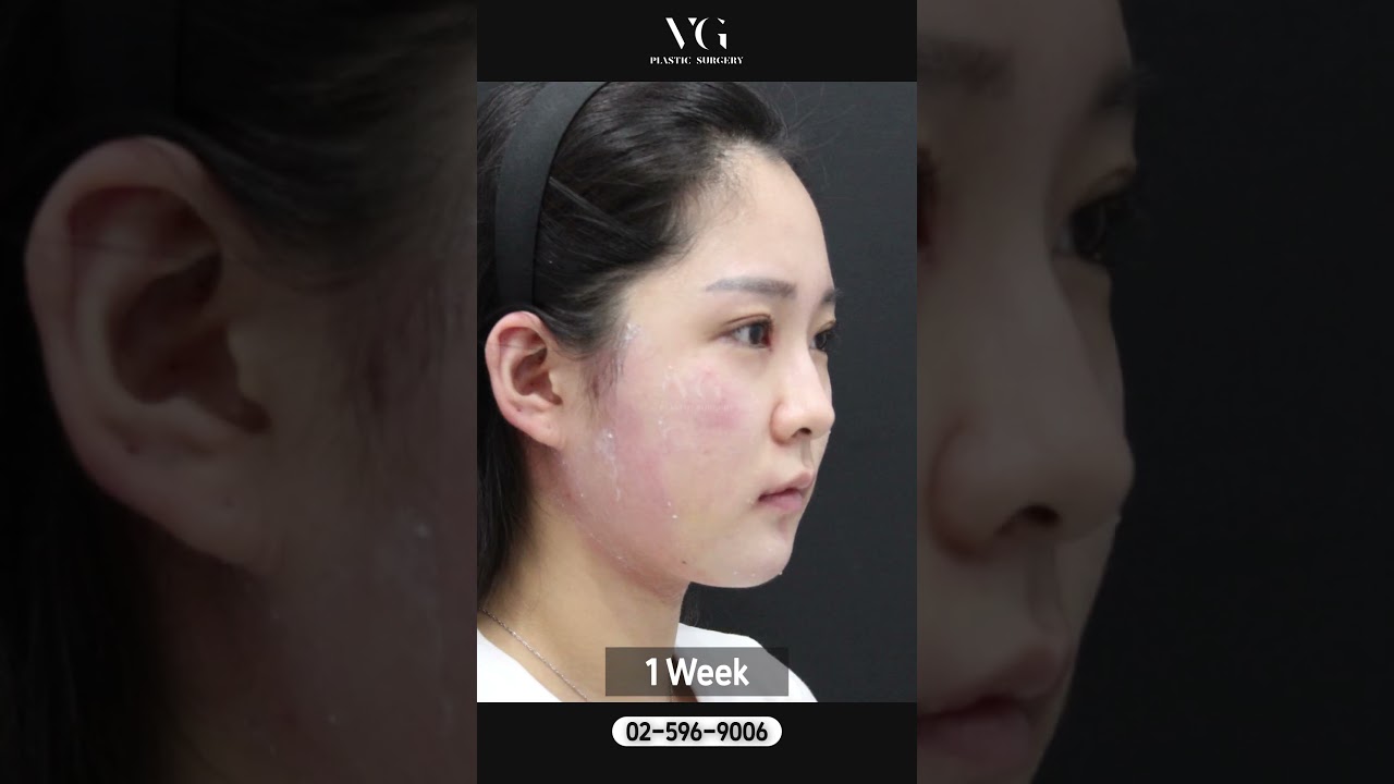 [БерриГүүд гоо сайхны мэс заслын эмнэлэг] #Нүүрний_хэлбэр_засалт Хэлбэр засалт сайн хийдэг эмнэлэгт хэлбэр засалтаар хэрхэн үзэсгэлэнтэй болох вэ? Хичээлийн шинэ жил эхлэхийн өмнө хичээлийн жилийн дагина болох аргыг БерриГүүдээс танд хэлж өгье🌸🌸