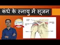 Rotator Cuff  Tendinitis.कंधे के स्नायु में सूजन