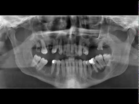 Video: Zyste An Der Zahnwurzel - Ursachen, Symptome, Behandlung