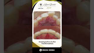 Invisalign Treatment – Before &amp; After | ACME Dental Lounge