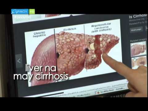Video: Paano Mag-diagnose ng Kanser sa Atay (na may Mga Larawan)