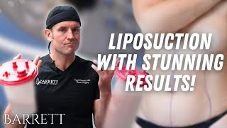 Amazing Abdominal Liposuction! | Barrett