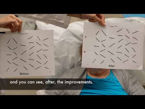 Improvement in left-side neglect and pain minutes after treatment by Edward Tobinick, M.D.