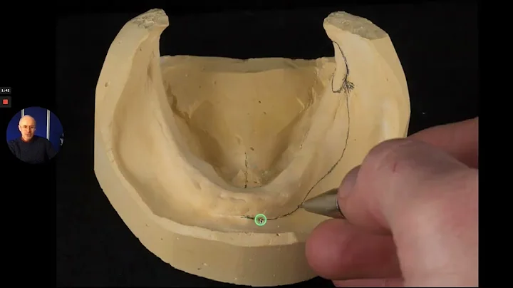 Complete denture lower custom special tray design - Finlay describes how to design this