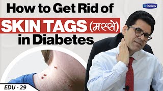 मस्से या Skin Tags आपकी Skin पर क्यों हो जाते हैं | Skin Problems Among Diabetics | Diabexy EDU 29