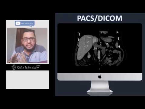 Vídeo: Radioterapia Para Trombo Tumoral Da Veia Cava Inferior Em Pacientes Com Carcinoma Hepatocelular