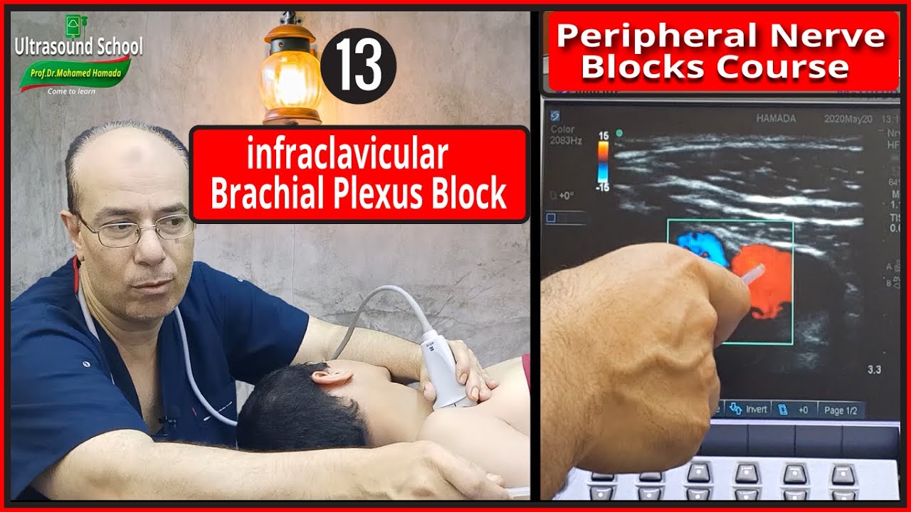 Infraclavicular Plexus Block)Ultrasound Guided peripheral Nerve Blocks
