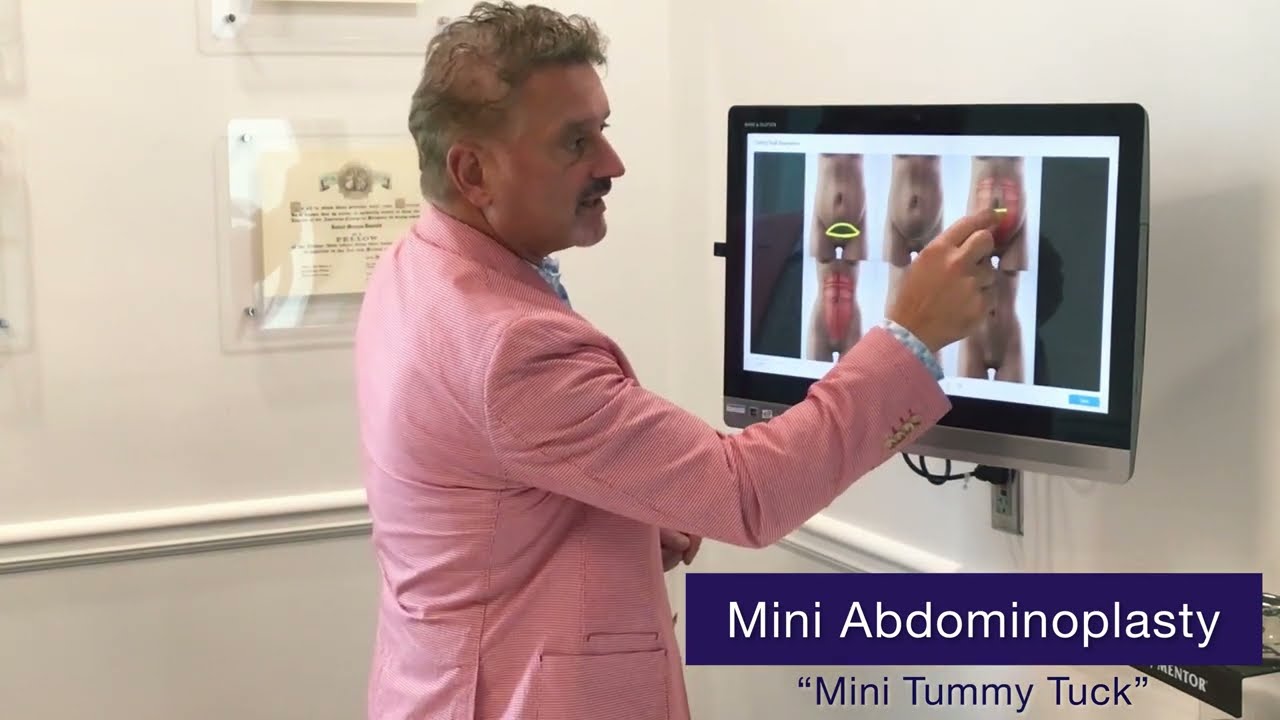 Abdominoplasty Surgery in Atlanta Georgia | Tummy Tuck Surgery