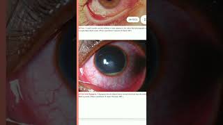 MBBS ,CORNEAL ULCER