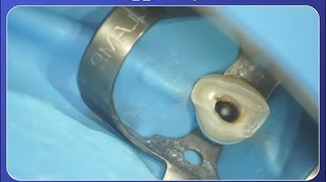 Apexification with MTA Apical Plug: Step-by-Step Dental Tutorial