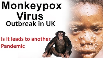 Monkeypox Virus Outbreak in UK. Is It leads to another Pandemic