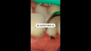 Super SATISFYING Dental Cleaning! #shorts