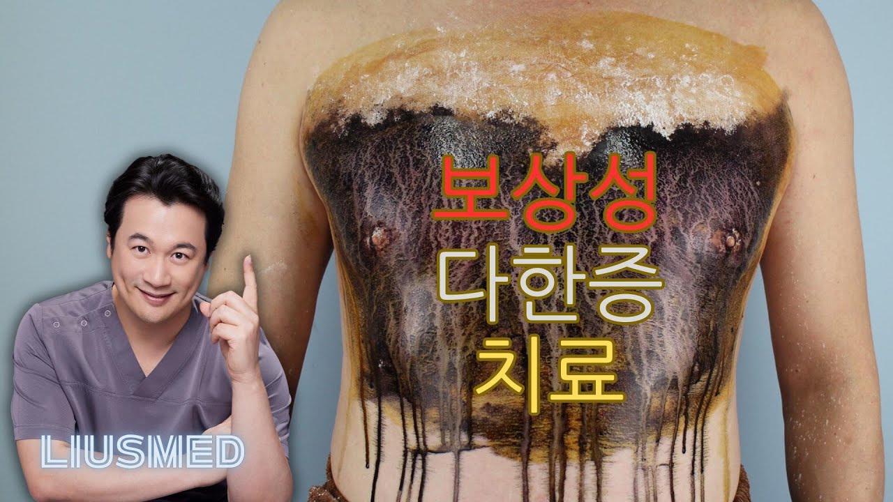 보상성 다한증 치료: 비침습적 땀샘 열분해