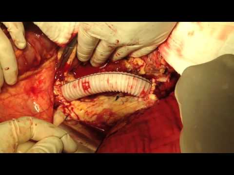 Ep.24 Abdominal aortic aneurysm