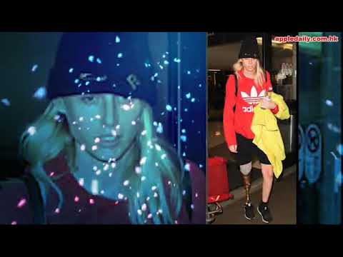【單腳女模】棉條感染中毒截肢 「將要切埋另一隻腳」  即時新聞  國際  20171220
