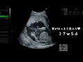【妊娠5ヶ月】17週エコー動画 / 4Dエコー/ エンジェルメモリー / 性別判明!?