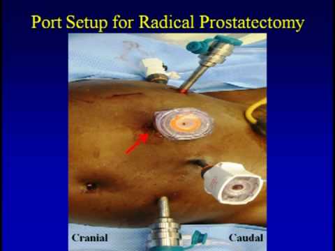 Robotic Partial Nephrectomy and Radical Prostatectomy in a Single Setting: Technique and Results