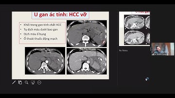 Chẩn đoán hình ảnh cấp cứu bụng không do chấn thương | PGS. Lê Thanh Dũng
