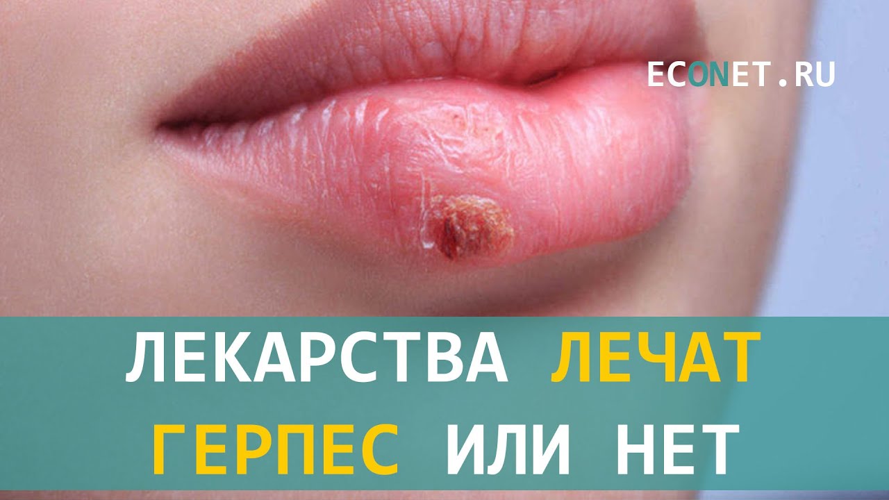 Лекарства лечат герпес или нет | ECONET.RU - YouTube