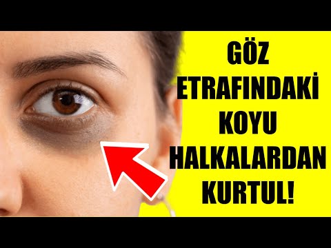 GÖZ ETRAFINDAKİ KOYU HALKALARDAN KURTULMA YÖNTEMLERİ