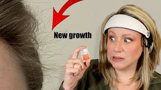Hormonal Hair Loss: Do serums work? What about Growband?