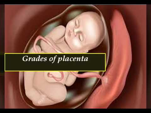 Video: Hvad er en grad 1 placenta?
