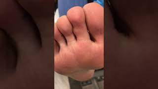 Ganglion cyst toe