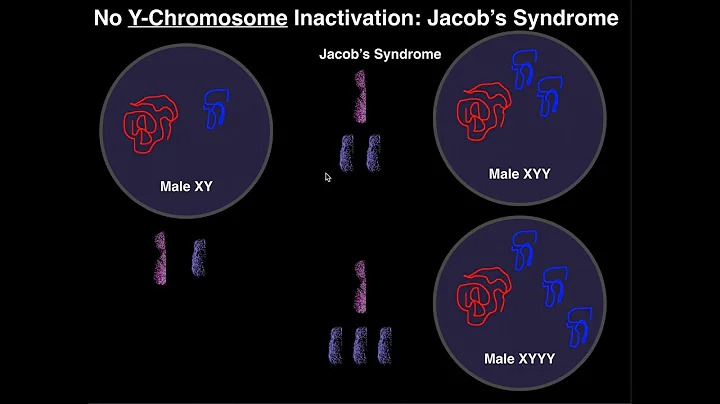 Jacob's Syndrome | A Y-Chromosome Aneuploidy
