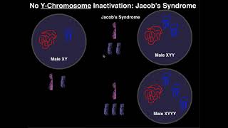 Jacob's Syndrome | A Y-Chromosome Aneuploidy Jacob's Syndrome | A Y-Chromosome Aneuploidy