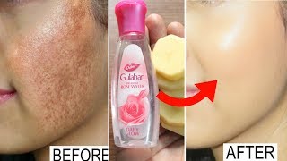 7 दिन में पुराने से पुराने दाग-धब्बे, झाइयां व निशान को जड़ से ख़त्म करे- Remove Pigmentation 7 day