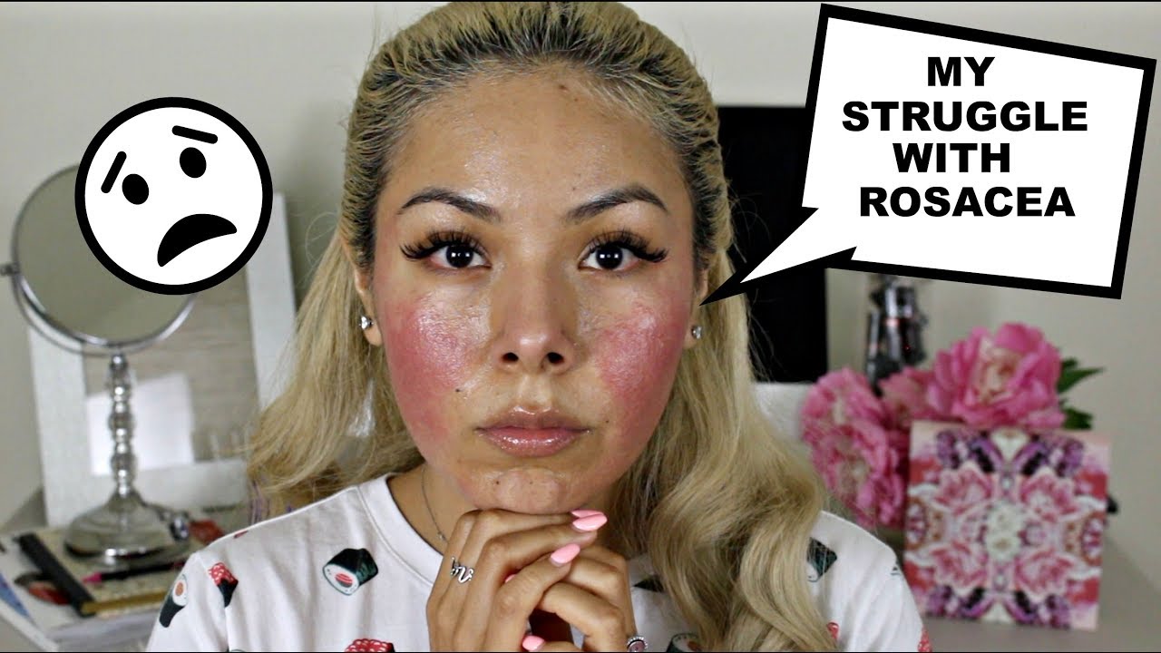 MY STRUGGLE WITH ROSACEA|| MY NEW NORMAL.