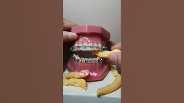 Bật mí loại snack unhealthy mà khi niềng răng vẫn ăn được.Dr Ngọc Yến#niềng_răng #niengrangmaccai