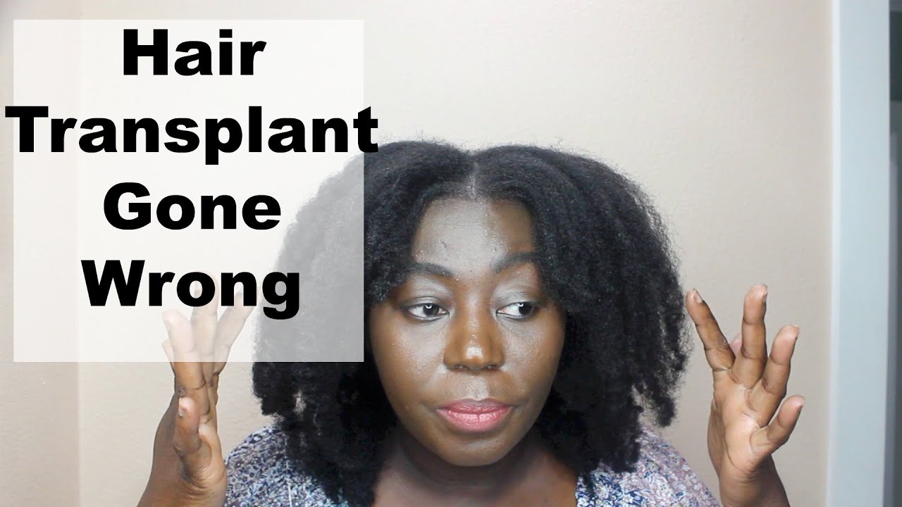 A Failed Hair Transplant: The Ugly Truth No One Talk About.