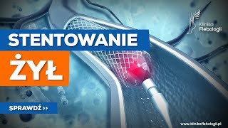 Stentowanie Żył - Jak Przebiega Zabieg?