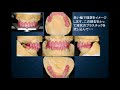 咬み合わせ再構築（松翁会歯科診療所）