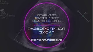 &quot;РАСТЯНУТОЕ&quot; ОТКРЫТОЕ ОВАЛЬНОЕ ОКНО. Эхокардиография. STRETCHED  PFO. Echocardiography.