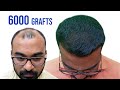 Best Hair Transplant Result In India |  Grade 6 Baldness - 6000 Grafts |