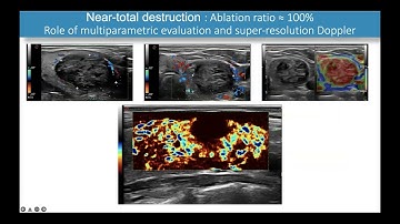 Thyroid Nodule Therapies (TNT) Association Webinar on Thyroid Radiofrequency ablation