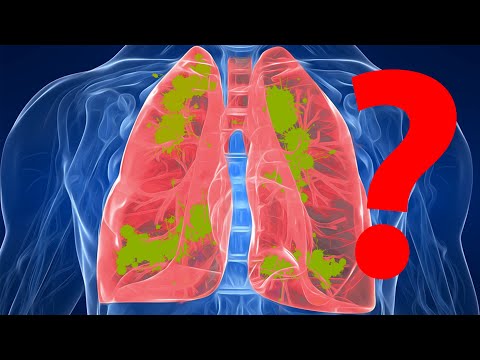 Video: Fibrosi Cistica E Trapianti Polmonari: Cosa Dovresti Sapere