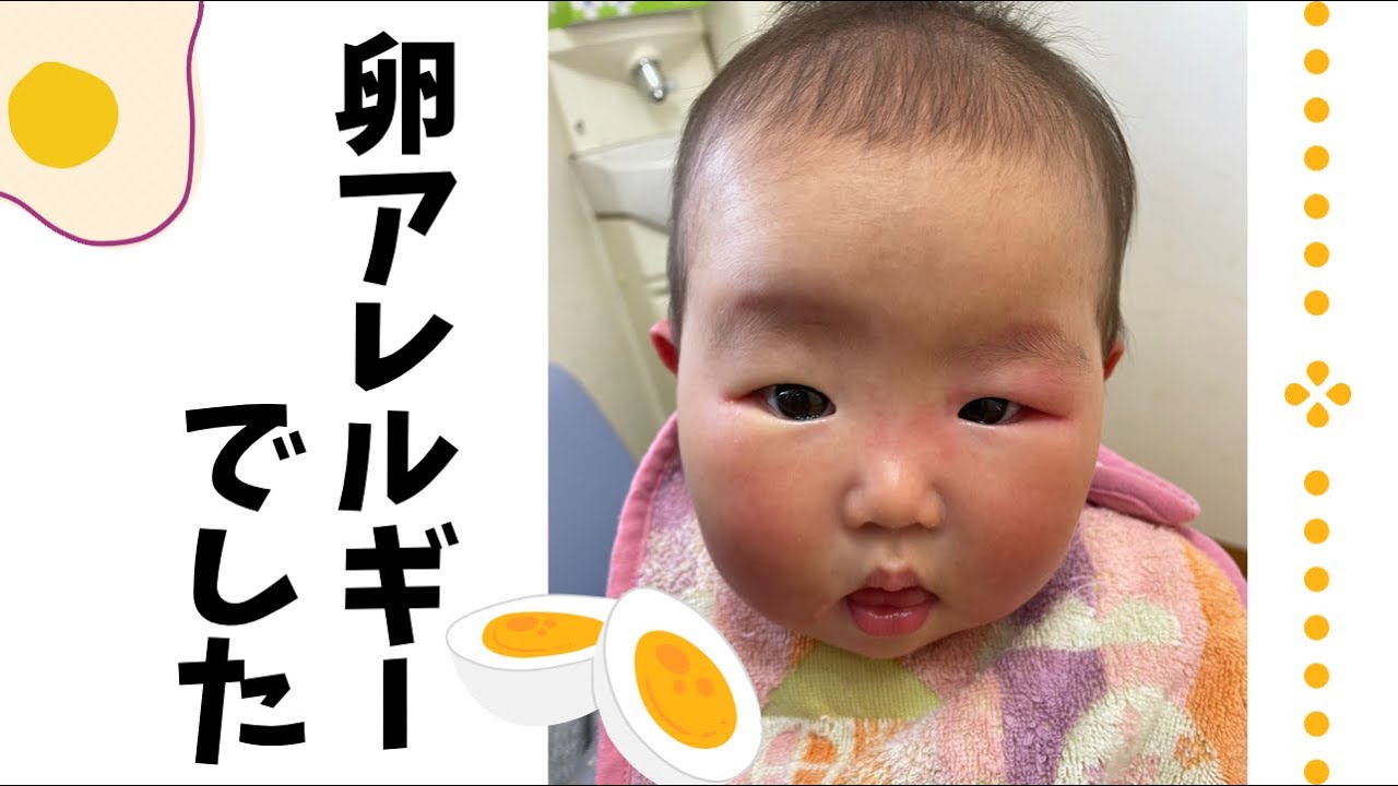 生後8ヶ月 アレルギー症状出てママがパニックになりそうでした Youtube