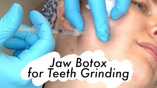 I Got Botox in My Jaw to Stop Teeth Grinding & Tension Headaches!