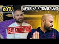 My conditions after hair transplant  kotli hair transplant sadaqits vlogs