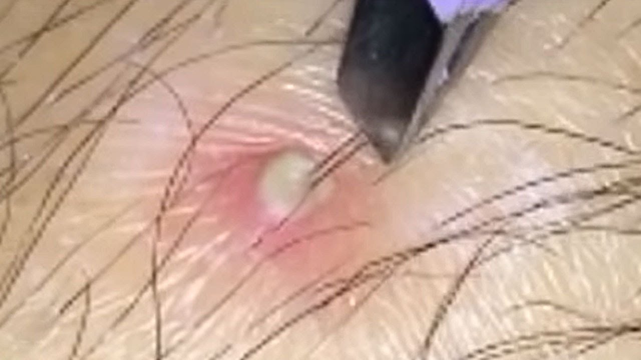 Dilated Pores, Waxing, Blackheads & Pimple Popping 2018 - YouTube