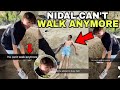 Nidal wonder cant walk anymore after his terrible car accident  with proof