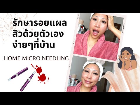 รักษารอยแผลสิวด้วยตัวเองง่ายๆที่บ้าน | การทำ Micro needling ที่บ้าน, ได้ผลเทียบเท่ากับการเข้าร้านคะ